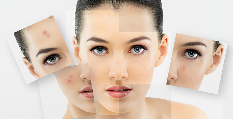 Laser Acne Treatments