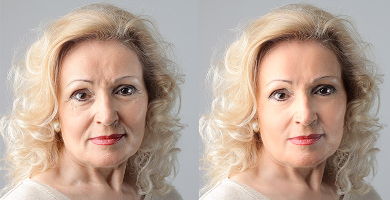 Laser Skin Tightening and Wrinkle Reduction